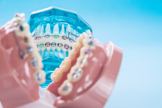 Photo gros plan modèle orthodontique et outil de dentiste sur le fond bleu