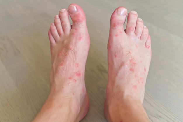 Gros plan sur de nombreuses piqûres de moustiques sur la peau des pieds des hommes