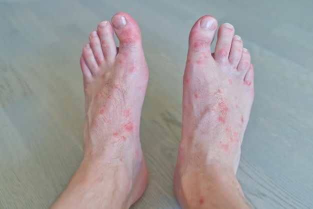 Gros plan sur de nombreuses piqûres de moustiques sur la peau des pieds des hommes