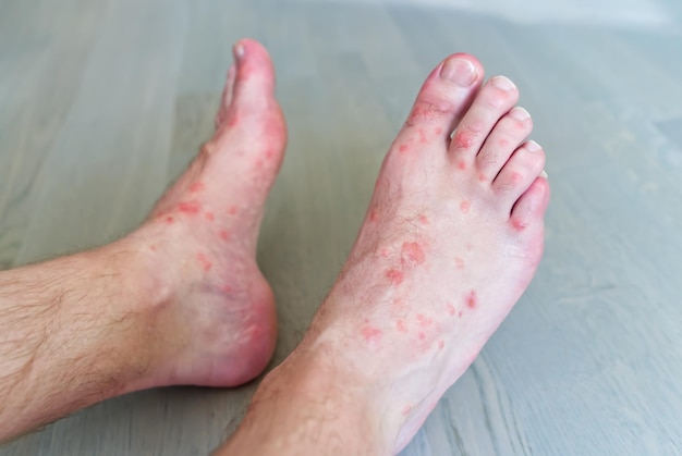 Gros plan sur de nombreuses piqûres de moustiques sur la peau des pieds des hommes