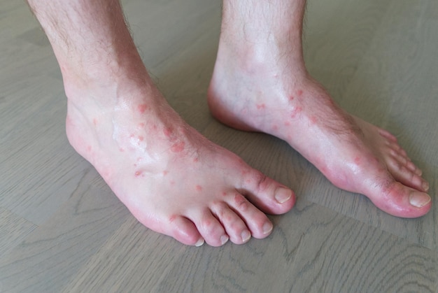 Gros plan sur de nombreuses piqûres de moustiques sur la peau des pieds des hommes