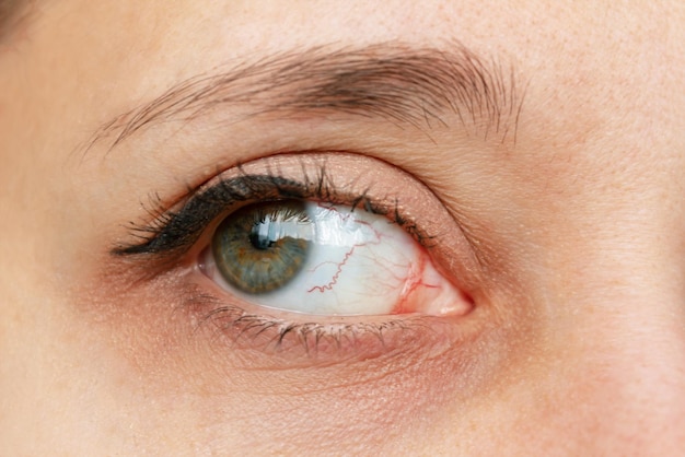 Gros plan de l'œil féminin avec des capillaires rouges enflammés et dilatés Syndrome de l'œil sec kératite