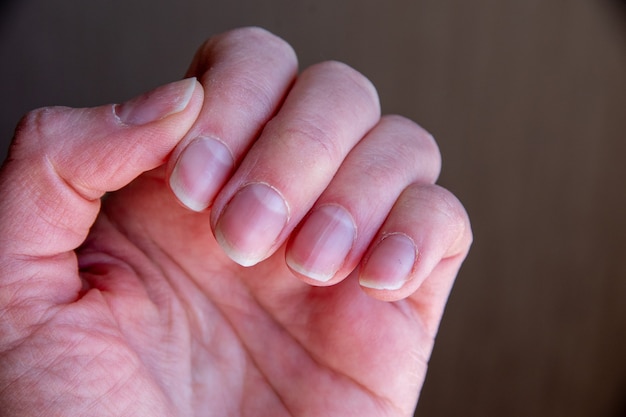 Gros plan des ongles féminins après une mauvaise manucure sur fond marron. Ongles envahis par la cuticule et plaque à ongles endommagée