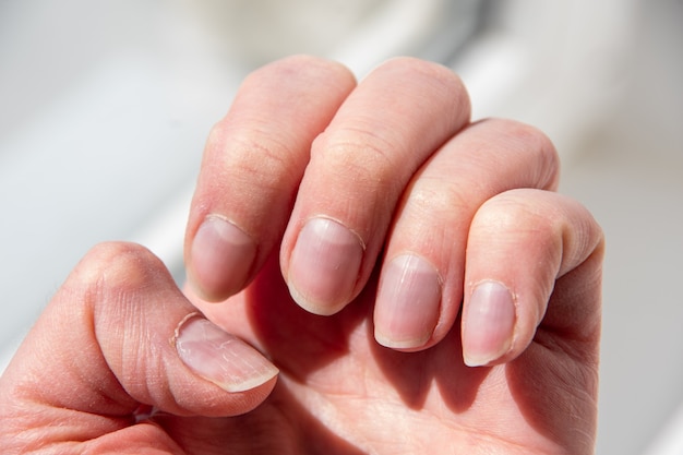 Gros plan sur les ongles de la femme après une mauvaise manucure. Ongles envahis par la cuticule et plaque à ongles endommagée. Concept de santé et de soins.