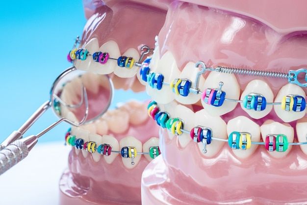 Gros plan des outils de dentiste et modèle orthodontique