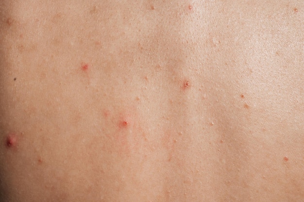 Photo gros plan de la peau d'une jeune fille avec des problèmes de cicatrices de pores d'acné de boutons peau naturelle sans filtres