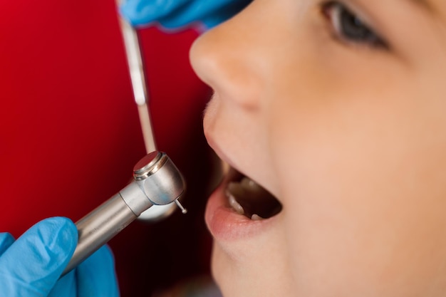 Gros plan sur une perceuse dentaire Dentiste enfant forant les dents d'une fillette dans une clinique dentaire Traitement des dents Remplissage dentaire pour enfant patient