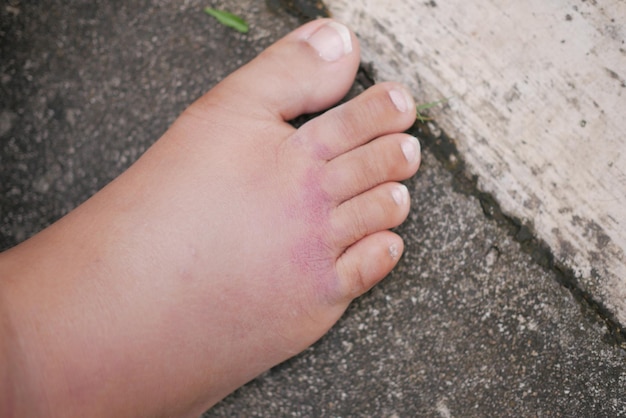 Gros plan des pieds de femmes avec gonflement