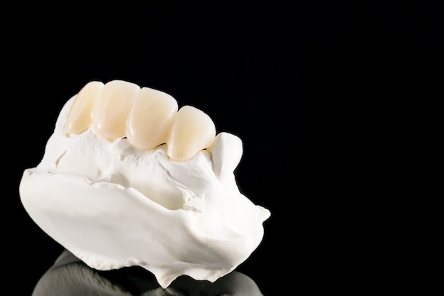 Gros plan / prosthodontie ou prothèse / couronne dentaire et équipement de dentisterie implantaire de bridge et restauration de modèle express fix.