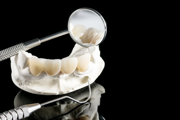 Gros plan / prosthodontie ou prothèse / couronne dentaire et équipement de dentisterie implantaire de bridge et restauration de modèle express fix.