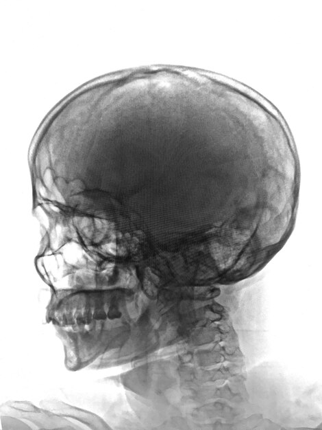 Un gros plan d'une tête humaine avec le cerveau visible.