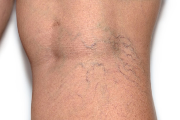 Gros plan sur les varices variqueuses sur la peau d'une femme âgée à la jambe d'un escroc, Problème de thrombose pouvant provoquer la coagulation des vaisseaux sanguins, Maladies vasculaires et veineuses, Soins de santé avant le médecin sur fond blanc