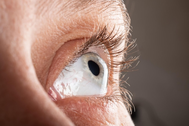 Photo gros plan sur les yeux du kératocône amincissement de la cornée