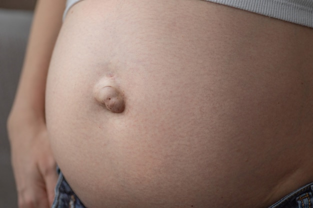 Photo hernie ombilicale chez une femme enceinte. fermer. le concept de santé et de vie