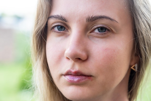 Herpès sur les lèvres de la jeune femme gros plan