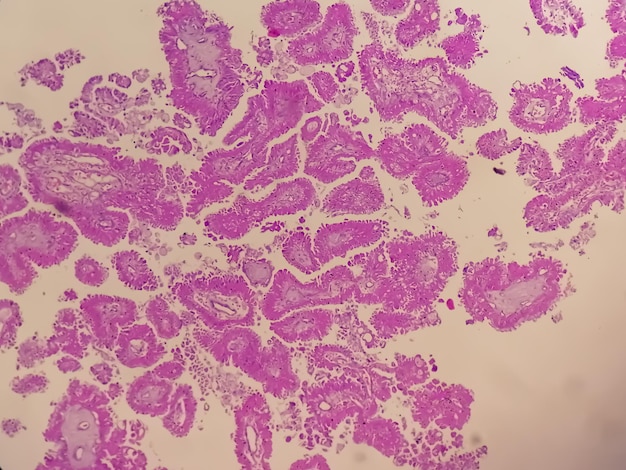 Histologie de l'adénocarcinome papillaire métastatique