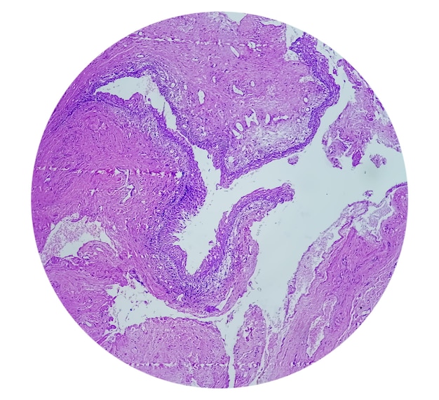 Histologie du kyste de l'ouraque Photomicrographie de la lame colorée histologique montrant le kyste de l'ouraque