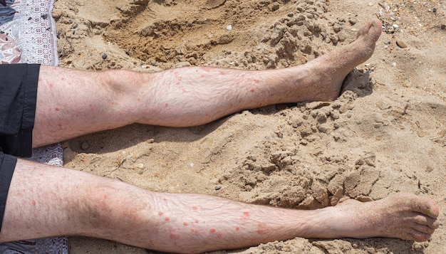 Un Homme Adulte En Train De Bronzer Se Trouve Sur Le Sable Avec Des Jambes Pâles Avec Des Taches Rouges De Maladie De La Peau Du Psoriasis