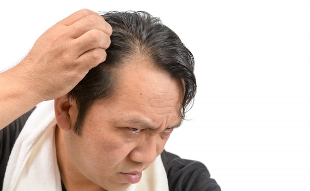 Homme asiatique s&#39;inquiète de sa perte de cheveux ou d&#39;alopécie isolée