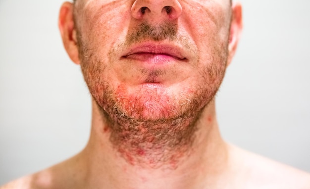 Homme atteint de dermatite séborrhéique dans la zone de la barbe