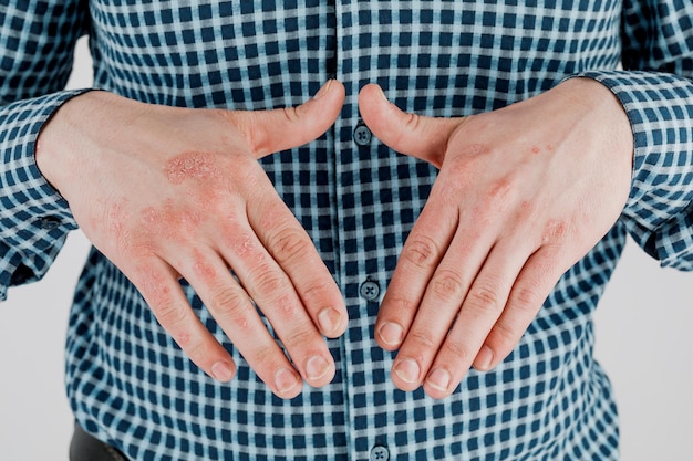 L'homme aux mains malades sèche la peau squameuse sur sa main avec un eczéma de psoriasis vulgaire et d'autres maladies de la peau telles que l'éruption de la plaque fongique et les imperfections Maladie génétique auto-immune