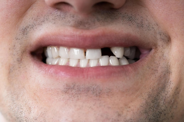 Homme avec une dent manquante