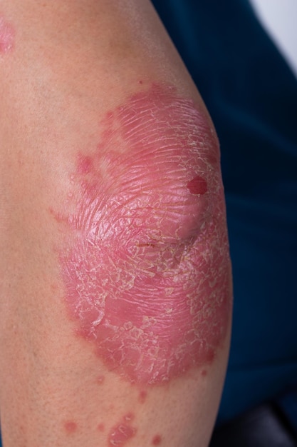 Un homme méconnaissable se sent mal sur une maladie de la peau appelée psoriasis Grande éruption cutanée enflammée rouge sur les coudes