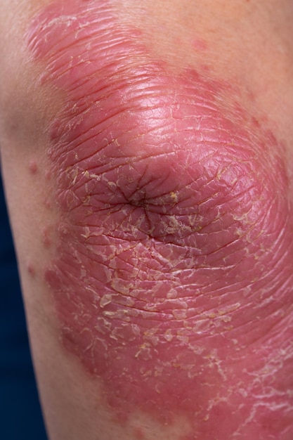 Un homme méconnaissable se sent mal sur une maladie de la peau appelée psoriasis Grande éruption cutanée enflammée rouge sur les coudes