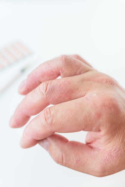 Un homme montre une éruption cutanée rougissante sur ses mains Les causes des démangeaisons de la peau peuvent être la dermatite l'eczéma la peau sèche brûle les allergies alimentaires le concept de soins de santé