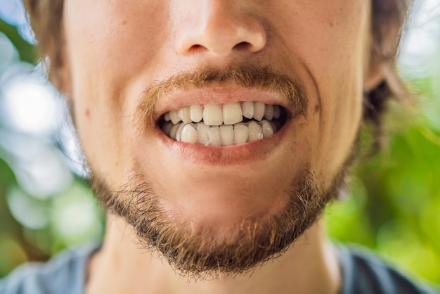 Homme plaçant une plaque de morsure dans sa bouche pour protéger ses dents la nuit du grincement causé par le bruxisme