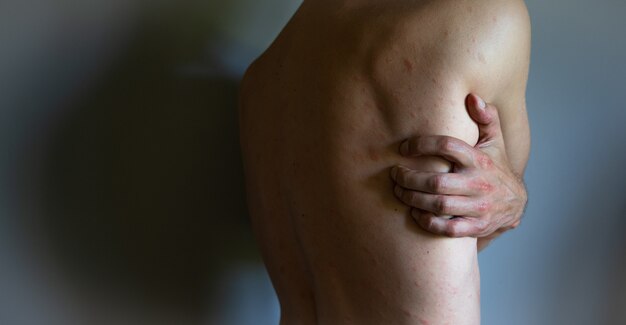 Homme présentant des symptômes d'urticaire prurigineuse. Guy se gratte le dos avec la main isolée sur fond gris.