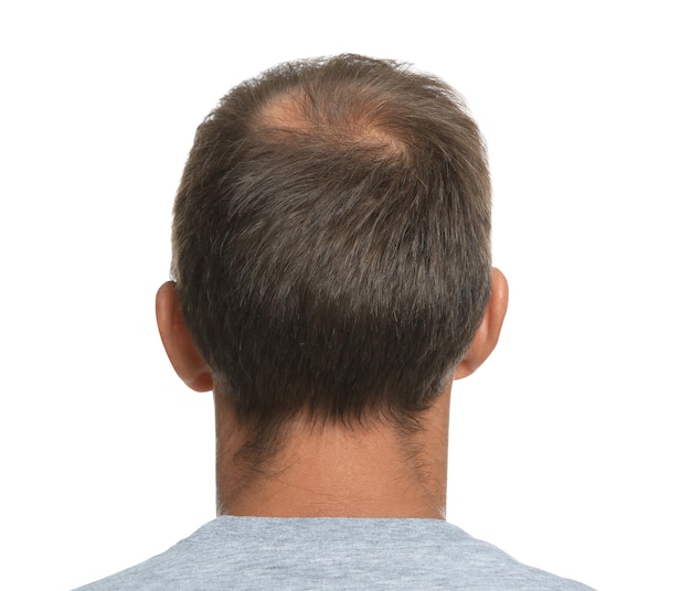 Photo homme avec problème de perte de cheveux sur fond blanc vue arrière