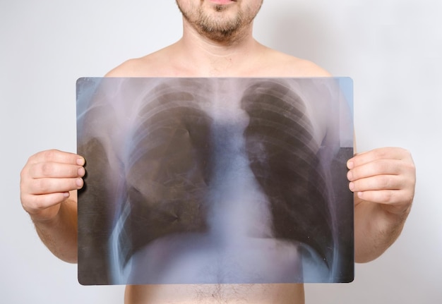 Un homme tient une photo d'une radiographie de ses poumons près de sa poitrine