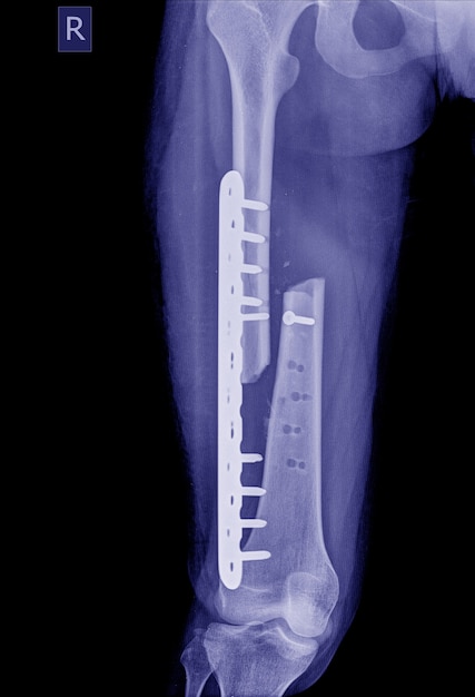 Image aux rayons X de la jambe cassée, image radiographique d&#39;une jambe fracturée avec plaque d&#39;implant et dislocation de la vis