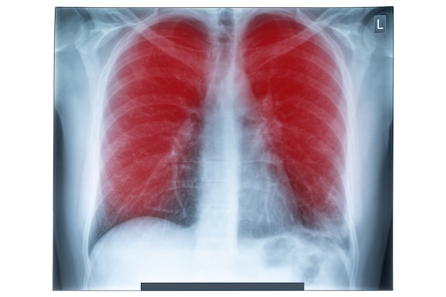 Image aux rayons X de la poitrine humaine pour un diagnostic médical.