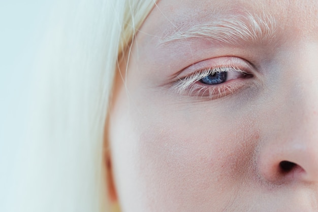 Image de beauté d'une fille albinos qui pose en studio portant de la lingerie