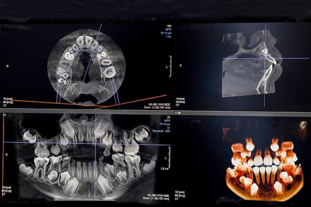 Image CT des dents d'un enfant de 9 ans avec des dents de lait dans différentes projections CBCT de deux mâchoires