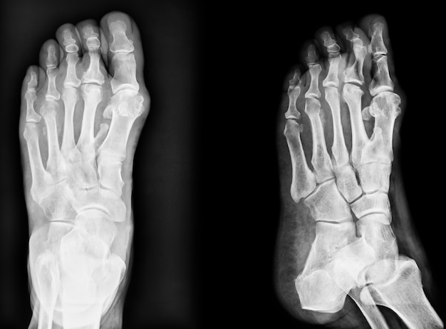 Image Gros Plan D'une Image De Radiographie Classique Des Pieds