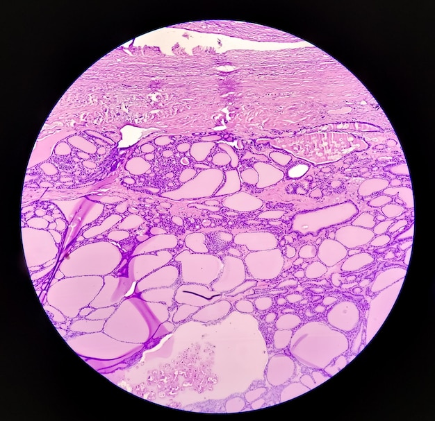 Image histologique du sarcome synovial analysée au microscope au laboratoire d'histopathologie. Cellule cancéreuse