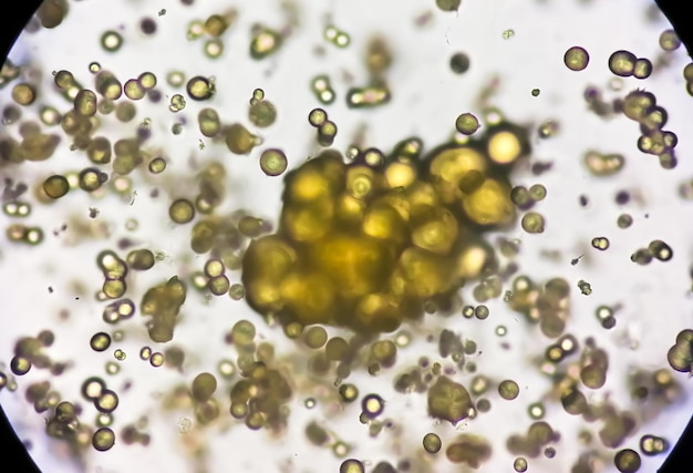 Image microscopique de l'analyse d'urine. Examen d'urine anormal. Cristaux d'acide urique.