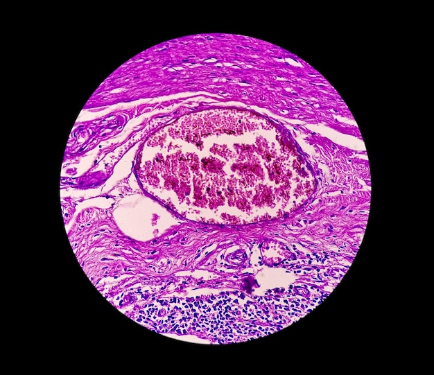 Image microscopique d'une coupe transversale d'un appendice chez un enfant atteint d'appendicite aiguë