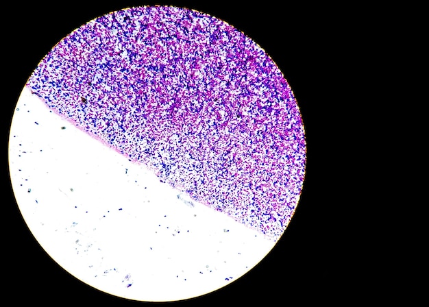 Image microscopique d'une lame histopathologique montrant un carcinome