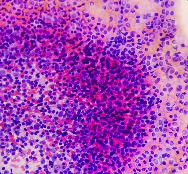 Image microscopique de lymphadénite chronique non spécifique ou CNSLA