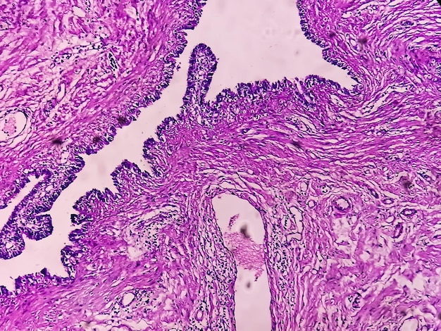 Image microscopique ou photomicrographie de la biopsie des trompes de Fallope