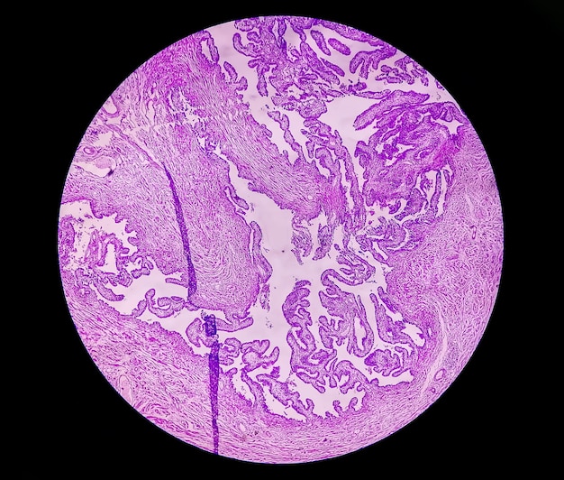 Image microscopique ou photomicrographie de la biopsie des trompes de Fallope