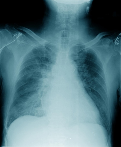 Image de radiographie pulmonaire dans un poumon bleu avec sécrétion dans le poumon