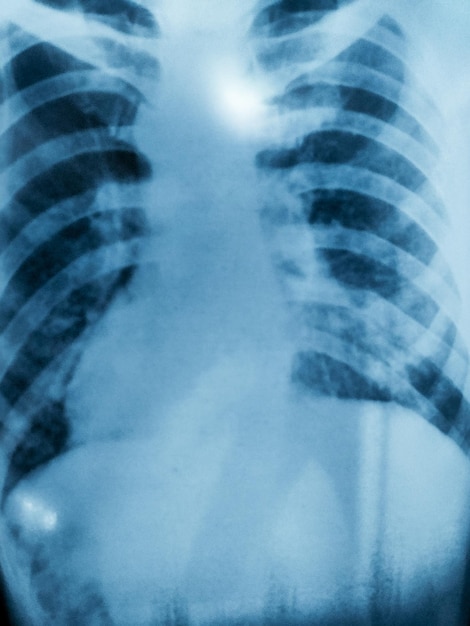 L'image de la radiographie pulmonaire d'un patient qui a quitté la tuberculose pulmonaire, test de technologie médicale