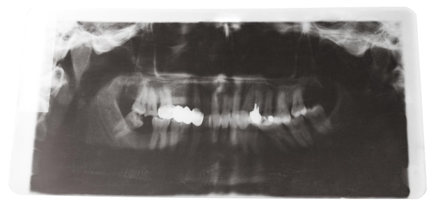 Image radiographique des mâchoires humaines avec couronne dentaire