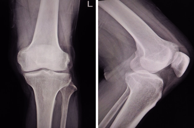 Image radiographique montrant les articulations du genou