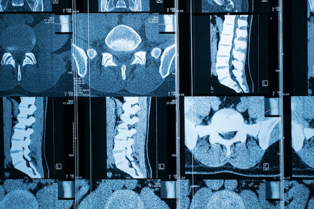 Imagerie par résonance magnétique IRM de la colonne vertébrale humaine